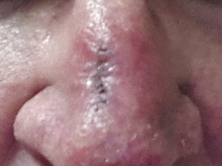 Waxy bump