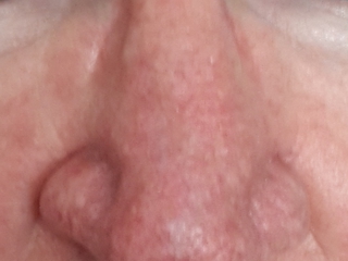 Waxy bump