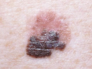 Melanoma