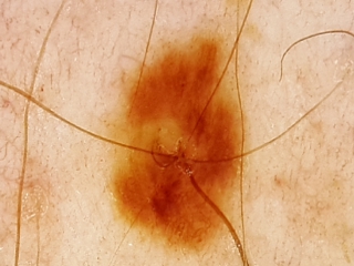 Melanoma